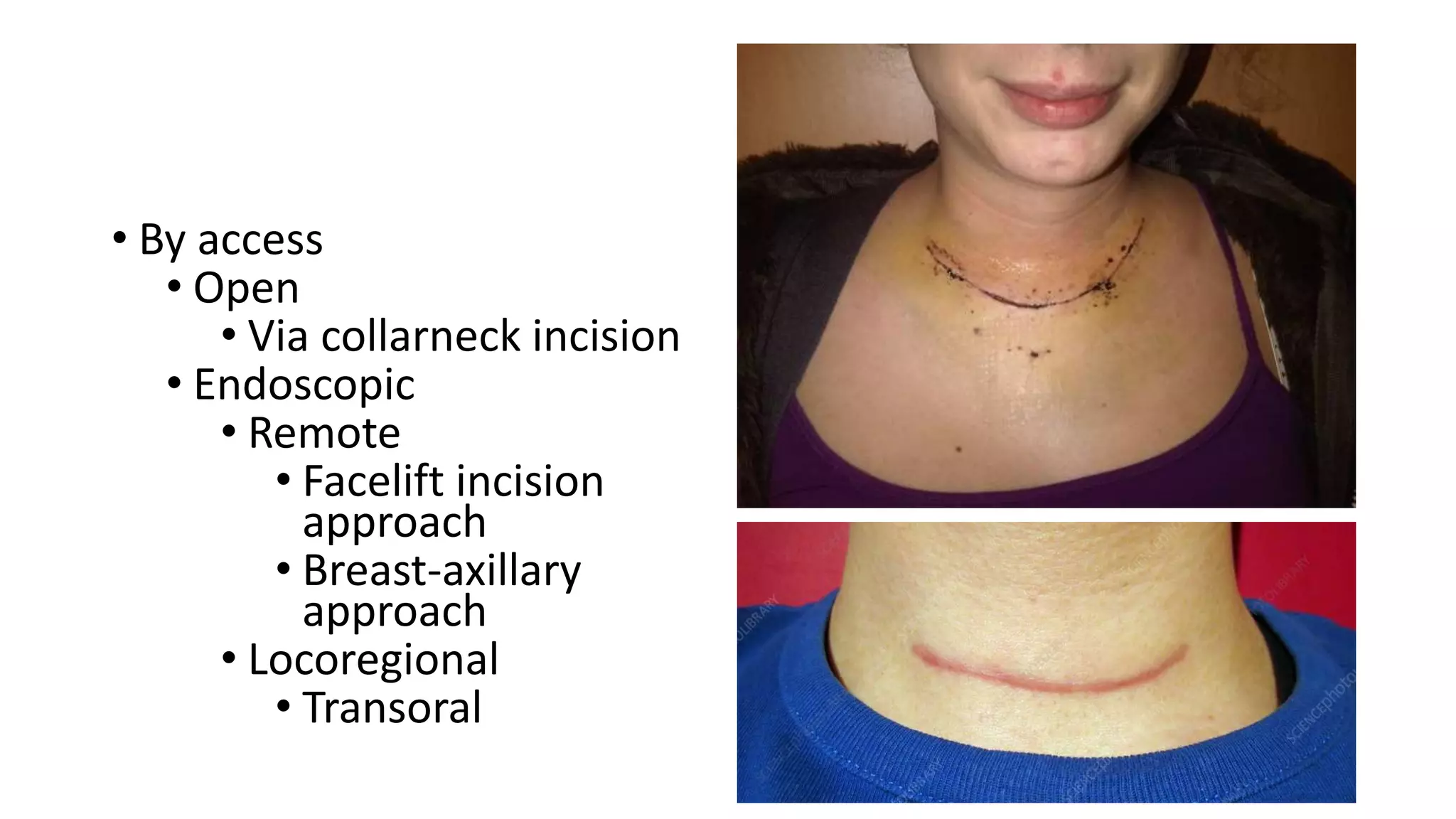 • By access
• Open
• Via collarneck incision
• Endoscopic
• Remote
• Facelift incision
approach
• Breast-axillary
approach
• Locoregional
• Transoral
 