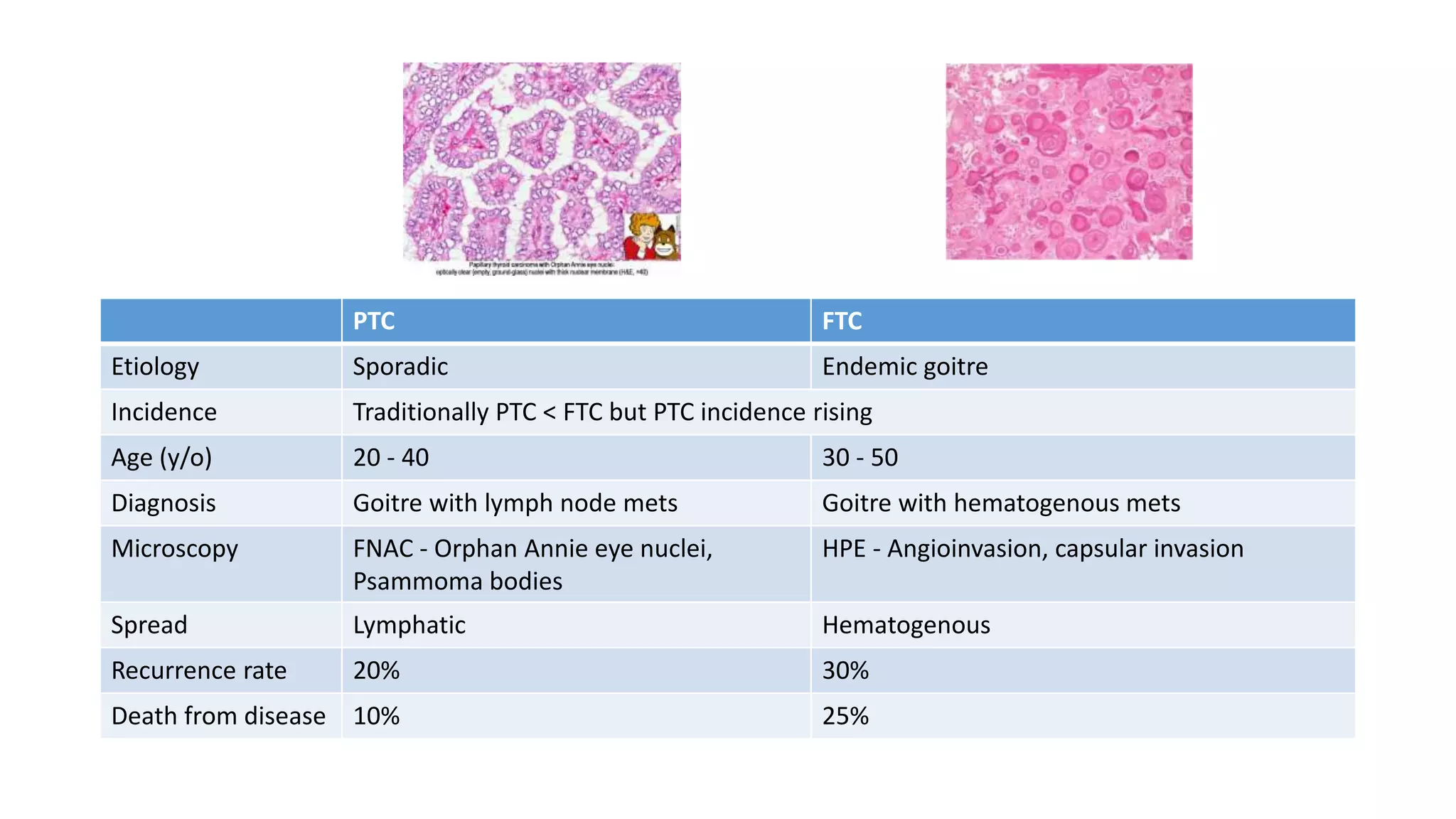 PTC FTC
Etiology Sporadic Endemic goitre
Incidence Traditionally PTC < FTC but PTC incidence rising
Age (y/o) 20 - 40 30 - 50
Diagnosis Goitre with lymph node mets Goitre with hematogenous mets
Microscopy FNAC - Orphan Annie eye nuclei,
Psammoma bodies
HPE - Angioinvasion, capsular invasion
Spread Lymphatic Hematogenous
Recurrence rate 20% 30%
Death from disease 10% 25%
 