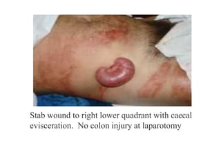 Stab wound to right lower quadrant with caecal
evisceration. No colon injury at laparotomy
 