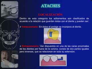 ATACHESMECANICA: es la resistencia relativa al movimiento entre dos o más superficies.IpsoclipFRICCIONAL-MECANICA: Es la combinación de ambos tipos de diseño antes mencionados.Schatzmann