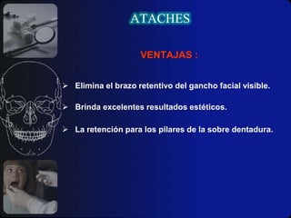 Extracoronario: Van dispuestos en una de las caras proximales de los dientes por fuera de la corona, consta de dos partes iguales pero inversas, que se relacionan en toda su extensión.ATACHESRadiculares e intrarradiculares: Denominados genéricamente “Botones de presión de anclaje recíproco” o bien “domos”, se trata de un tipo de retenedor ubicado sobre la cofia confeccionada en una raíz previamente tratada, o bien, son esferas o similares, pequeños que pueden ir soldados a la cofia.