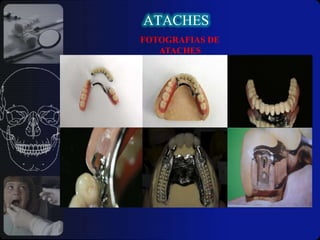 Higiene bucal consecuente.