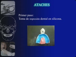 Incorporación exacta de todos los elementos de la Prótesis.