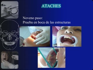 Inserción y remoción son arduas.ATACHES	¿Qué ventajas tienen los ataches sobre los retenedores en forma de gancho?      La eliminación de un componente retentivo visible y de un soporte vertical visible por medio de un lecho para apoyo ubicado más favorablemente en relación con el eje horizontal del diente pilar.	¿Por qué no se emplean frecuentemente los aditamentos?     Requieren pilares preparados y colados, requieren procedimientos clínicos y de laboratorio algo complicados, con el tiempo se desgastan, con la consiguiente perdida de resistencia friccional  a la remoción de la prótesis.