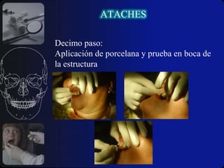 ATACHESVENTAJAS :  Elimina el brazo retentivo del gancho facial visible. 