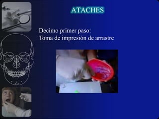  Brinda excelentes resultados estéticos.