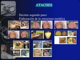  La retención para los pilares de la sobre dentadura.ATACHESDESVENTAJASAdecuada  y extensamente tallado. 
