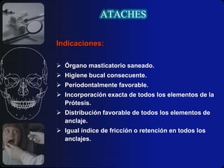 ATACHESFUNCIÓNNo resilentes: Estos sistemas teóricamente no permiten movimiento alguno entre sus componentes.