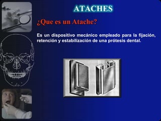 ATACHES¿Que es un Atache?Es un dispositivo mecánico empleado para la fijación, retención y estabilización de una prótesis dental.