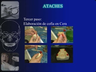 Distribución favorable de todos los elementos de anclaje.