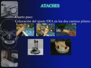 Igual índice de fricción o retención en todos los anclajes.ATACHESContraindicaciones :Actitud negativa del paciente por lo laborioso del proceso.