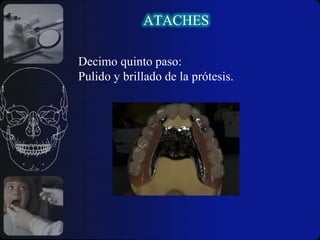  Problemas estéticos y técnicos  porque      ocupa  parte del espacio destinado al diente      artificial.                                                                                                                               El atache está sometido al desgaste como      resultado de su función entre las partes      metálicas lo  que conlleva aun problema de       mantenimiento.