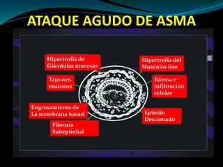 ATAQUE AGUDO DE ASMA
Hipertrofia del
Musculos liso
Edema e
infiltración
celular
Epitelio
Descamado
Fibrosis
Subepitelial
Engrosamiento de
La membrana basasl
Tapones
mucosos
Hipertrofia de
Glándulas mucosas
 