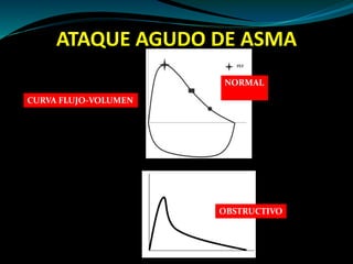 ATAQUE AGUDO DE ASMA
CURVA FLUJO-VOLUMEN
NORMAL
OBSTRUCTIVO
 