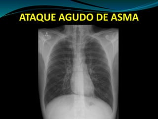 ATAQUE AGUDO DE ASMA
 