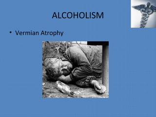 ALCOHOLISM
• Vermian Atrophy
 