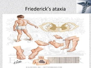 Friederick’s ataxia
 