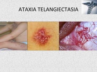 ATAXIA TELANGIECTASIA
 