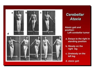 Ataxia cerebelosa | PPT