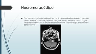 Neuroma acústico
 Este tumor surge a partir de células de Schwann do oitavo nervo craniano
(normalmente a sua porção vestibular) e é, assim, encontrado no ângulo
cerebelopontino. Ela se expande lentamente e pode atingir um tamanho
considerável
 