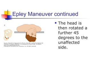 Epley Maneuver continued
                  The head is
                   then rotated a
                   further 45
                   degrees to the
                   unaffected
                   side.
 