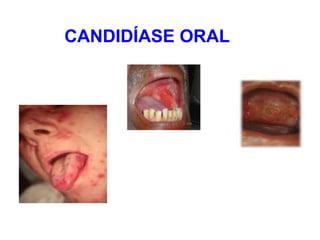 CANDIDÍASE ORAL
 
