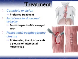 TreatmentTreatment
 Complete excision
 Preferred treatment
 Partial excision & mucosal
stripping
 To avoid compromise of the esophageal
lumen
 Resection& esophagotomy
closure
 Buttressing the closure with
a pleural or intercostal
muscle flap
 
