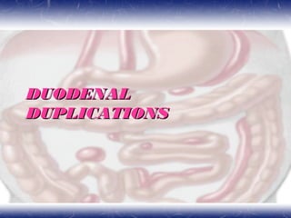 DUODENALDUODENAL
DUPLICATIONSDUPLICATIONS
 