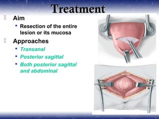 TreatmentTreatment
 Aim
 Resection of the entire
lesion or its mucosa
 Approaches
 Transanal
 Posterior sagittal
 Both posterior sagittal
and abdominal
 