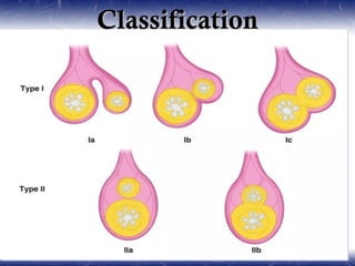 ClassificationClassification
I. Based on physical appearance
a. Cystic :75% of duplications
b. Tubular :25%
II. Pathological classification
a. Parenteral cystic type
b. Parenteral canal type
c. Parietal cyst type
d. Enteral septum type
e. Solitary type
III. Vascular classification
a. Type 1: parallel type
b. Type 2: intramesentric type
 