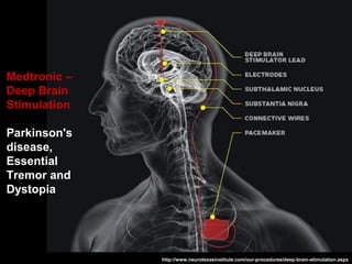 Medtronic –
Deep Brain
Stimulation
Parkinson's
disease,
Essential
Tremor and
Dystopia
http://www.neurotexasinstitute.com/our-procedures/deep-brain-stimulation.aspx
 