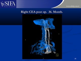 A technical modification of carotid endarterectomy experience with 400 ...
