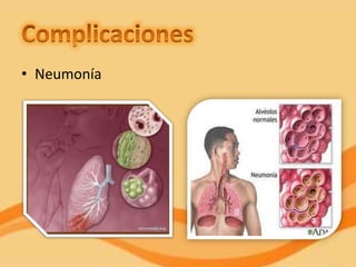 • Neumonía
 