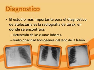 • El estudio más importante para el diagnóstico
  de atelectasia es la radiografía de tórax, en
  donde se encontrara:
  – Retracción de las cisuras lobares.
  – Radio opacidad homogénea del lado de la lesión.
 