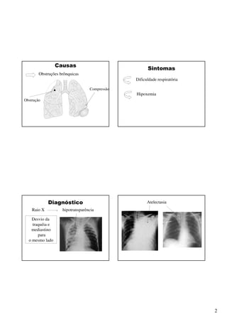 2
Causas
Obstruções brônquicas
Obstrução
Compressão
Sintomas
Dificuldade respiratória
Hipoxemia
Diagnóstico
Raio X hipotransparência
Desvio da
traquéia e
mediastino
para
o mesmo lado
Atelectasia