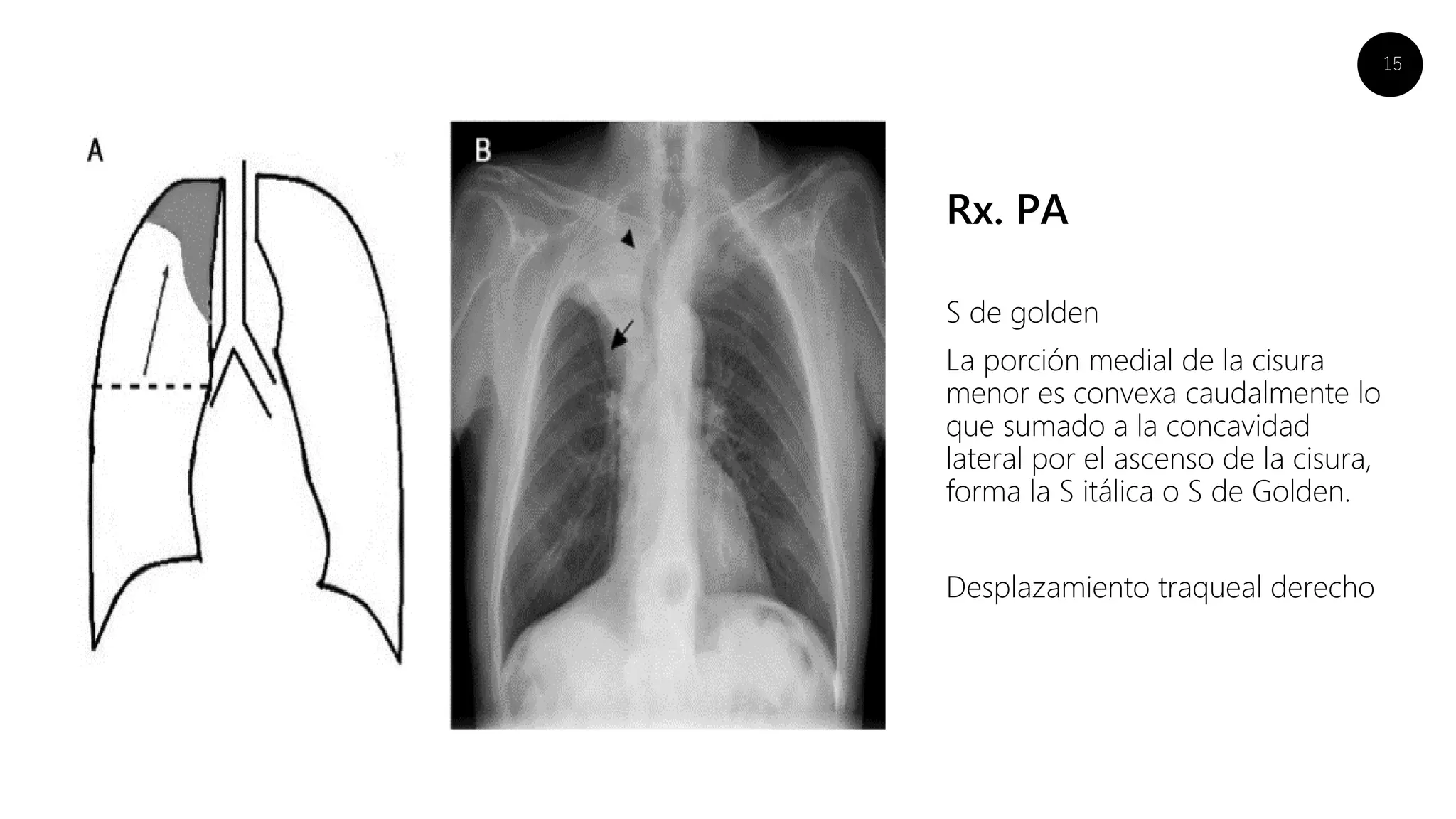 15
Rx. PA
S de golden
La porción medial de la cisura
menor es convexa caudalmente lo
que sumado a la concavidad
lateral por el ascenso de la cisura,
forma la S itálica o S de Golden.
Desplazamiento traqueal derecho
 