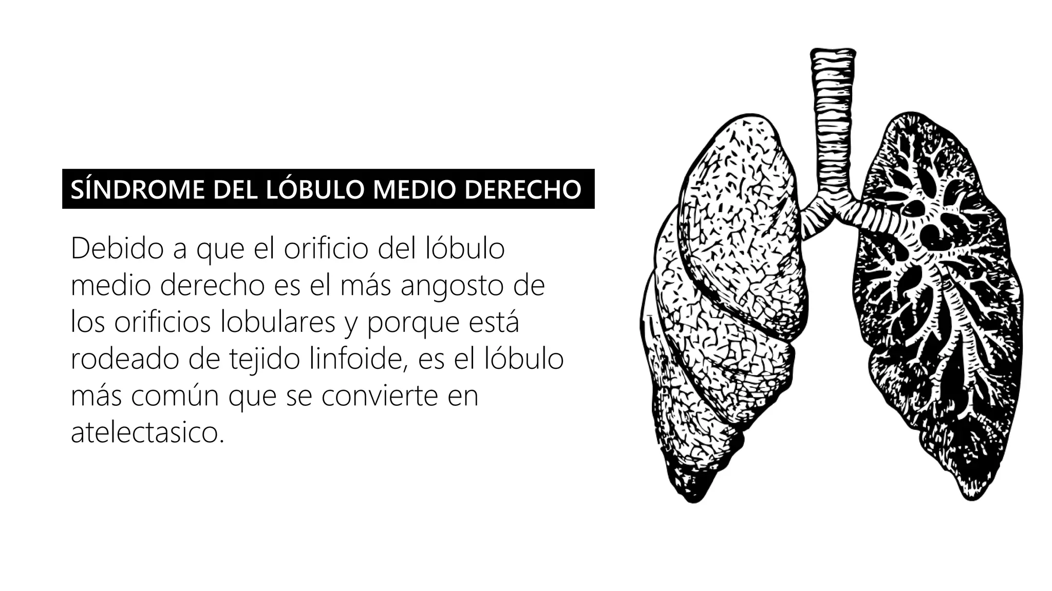 Debido a que el orificio del lóbulo
medio derecho es el más angosto de
los orificios lobulares y porque está
rodeado de tejido linfoide, es el lóbulo
más común que se convierte en
atelectasico.
SÍNDROME DEL LÓBULO MEDIO DERECHO
 