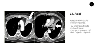 13
CT. Axial
Atelectasia del lóbulo
superior izquierdo.
Hay una masa ubicada
en el centro que
obstruye el bronquio del
lóbulo superior izquierdo
 