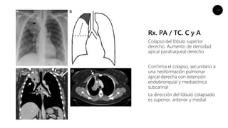 14
Rx. PA / TC. C y A
Colapso del lóbulo superior
derecho. Aumento de densidad
apical paratraqueal derecho.
Conﬁrma el colapso, secundario a
una neoformación pulmonar
apical derecha con extensión
endobronquial y mediastínica
subcarinal
La dirección del lóbulo colapsado
es superior, anterior y medial
 