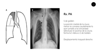 15
Rx. PA
S de golden
La porción medial de la cisura
menor es convexa caudalmente lo
que sumado a la concavidad
lateral por el ascenso de la cisura,
forma la S itálica o S de Golden.
Desplazamiento traqueal derecho
 