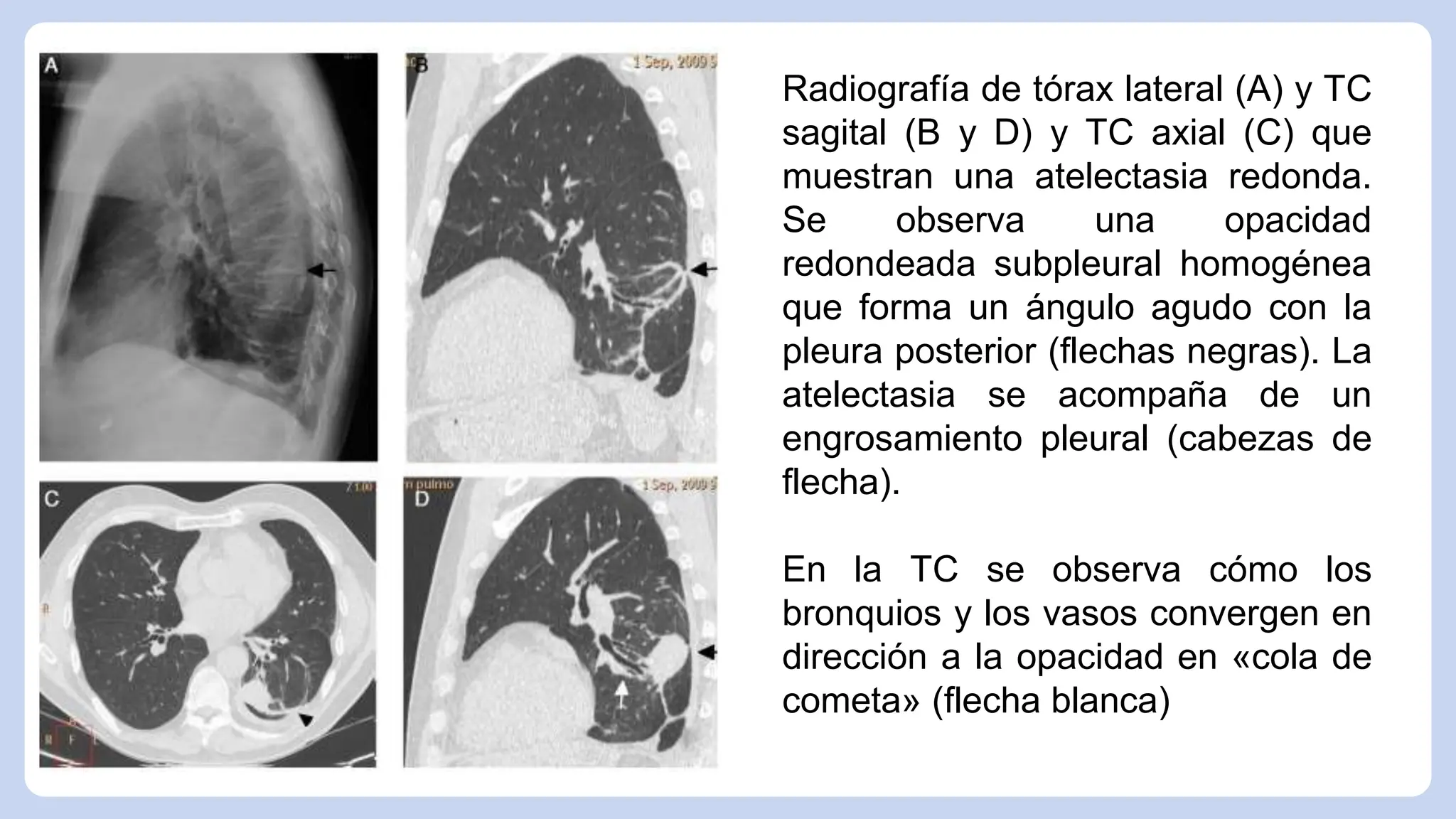 Atelectasias, tipos y hallazgos radiologicos mas comunes | PPTX