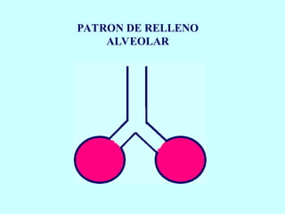 PATRON DE RELLENO
ALVEOLAR
 