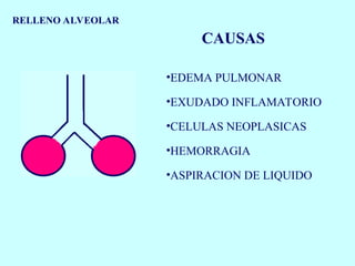 RELLENO ALVEOLAR
CAUSAS
•EDEMA PULMONAR
•EXUDADO INFLAMATORIO
•CELULAS NEOPLASICAS
•HEMORRAGIA
•ASPIRACION DE LIQUIDO
 