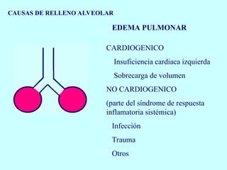 CAUSAS DE RELLENO ALVEOLAR
EDEMA PULMONAR
CARDIOGENICO
Insuficiencia cardiaca izquierda
Sobrecarga de volumen
NO CARDIOGENICO
(parte del síndrome de respuesta
inflamatoria sistémica)
Infección
Trauma
Otros
 
