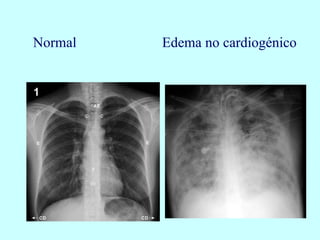 Normal Edema no cardiogénico
 