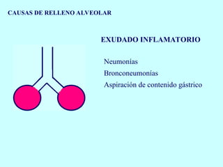 CAUSAS DE RELLENO ALVEOLAR
EXUDADO INFLAMATORIO
Neumonías
Bronconeumonías
Aspiración de contenido gástrico
 