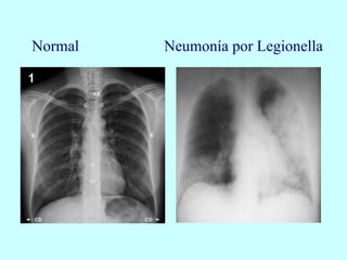 Normal Neumonía por Legionella
 
