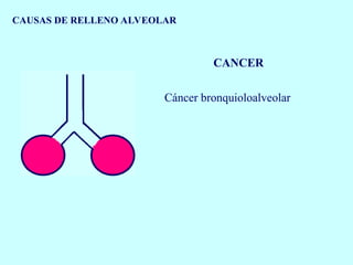 CAUSAS DE RELLENO ALVEOLAR
CANCER
Cáncer bronquioloalveolar
 