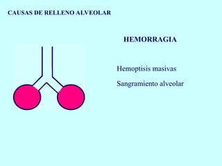 CAUSAS DE RELLENO ALVEOLAR
HEMORRAGIA
Hemoptisis masivas
Sangramiento alveolar
 