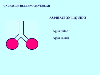 CAUSAS DE RELLENO ALVEOLAR
ASPIRACION LIQUIDO
Agua dulce
Agua salada
 